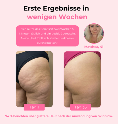 SkinGlow – Das 3-in-1 Anti-Cellulite Gerät